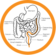 Flexible Sigmoidoscopy